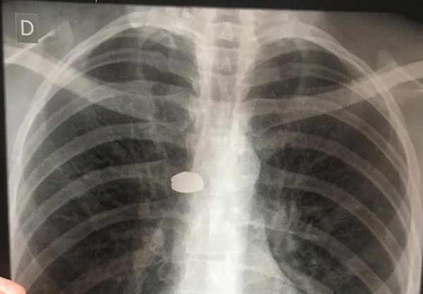 Suspeito invade propriedade de militar, tenta agressão, é baleado e socorrido por policiais em Arapiraca