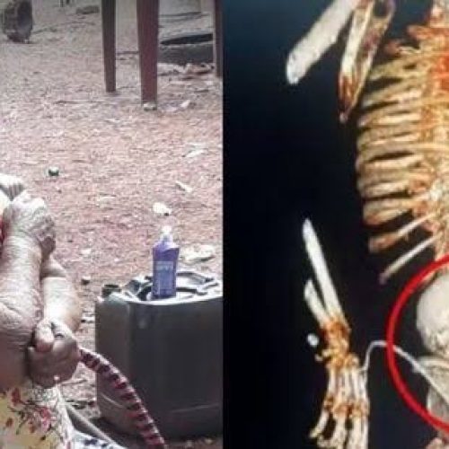 ‘Bebê de pedra’: idosa descobre feto calcificado que carregou por mais de 5 décadas e morre após cirurgia de retirada