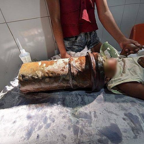 VÍDEO: MENINO DE 2 ANOS É RESGATADO APÓS FICAR COM A CABEÇA PRESA EM TUBO DE METAL EM CAPELA, ALAGOAS